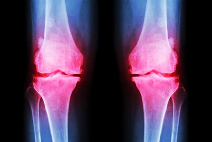Eingefärbtes Röntgenbild zweier Knier mit Arthrose