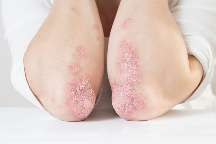 Ellbogen einer Frau mit Psoriasis.