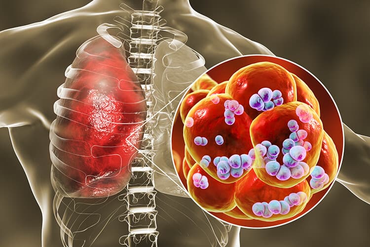 3D-Visualisierung von Streptococcus pneumoniae (Pneumokokken), Bakterien in den Lungenbläschen, die eine Lungenentzündung verursachen